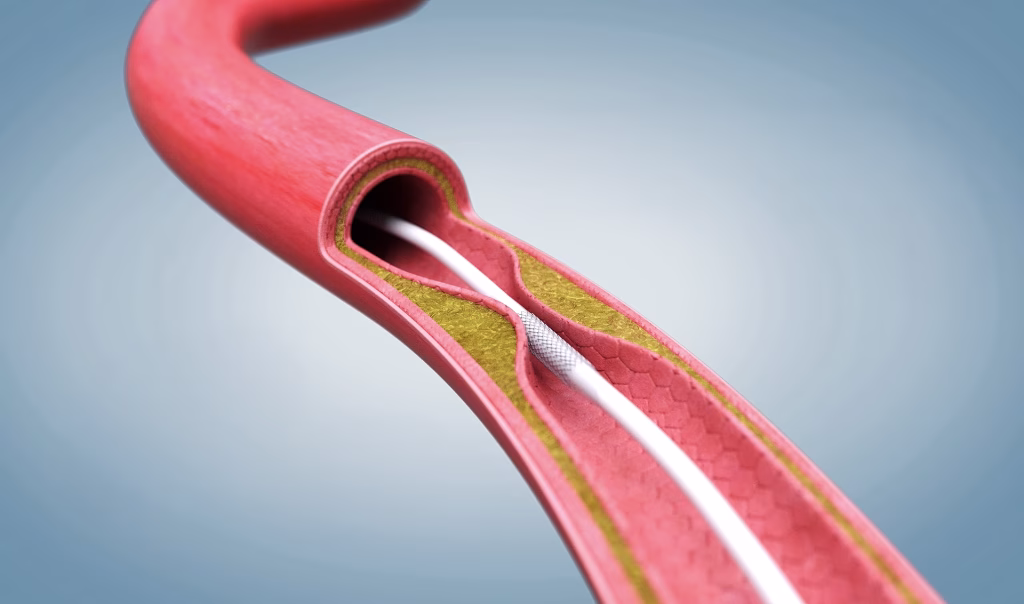 Animação 3D médica e ilustração de angioplastia para campanha publicitária hospitalar